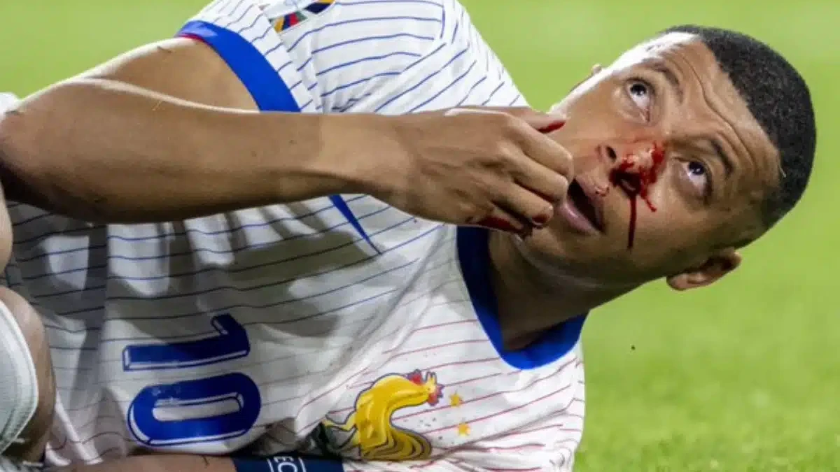 Euro 2024 : mauvaise nouvelle pour Kylian Mbappé, blessé au nez
